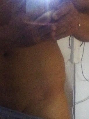 unzufriedenstellendes Ergebnis nach Laserlipolyse an den Hüften - 25599
