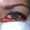 Unterlid-OP mit stark blutunterlaufenem Auge