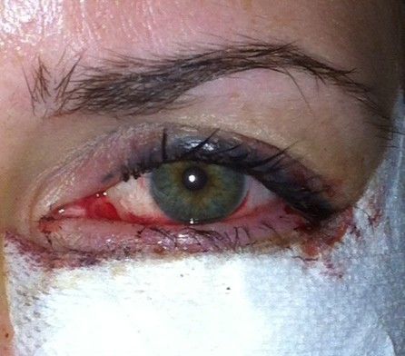 Unterlid-OP mit stark blutunterlaufenem Auge - 25630