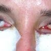 Unterlid-OP mit stark blutunterlaufenem Auge