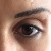 Augenlid-/ Oberlid- Korrektur - größere Augenhöhle - Methoden? - 25663