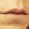 Extreme Schwellung nach Lippen Aufspritzen - 25667