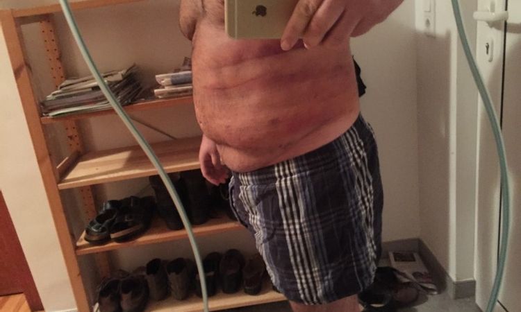 Fettabsaugung Bauch/Wasser angesammelt - 25742