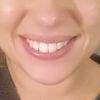 Lippen schief beim lächeln-Korrekturmöglichkeiten? Botox? - 25748