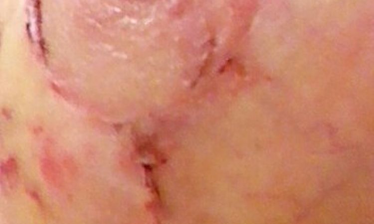Narbe Nässt Wochen nach OP - Decoderm/Tyrosurgel - 25751