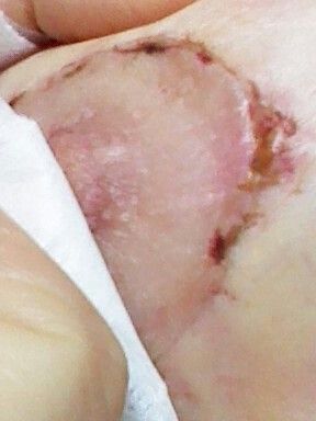 Narbe Nässt Wochen nach OP - Decoderm/Tyrosurgel - 25752