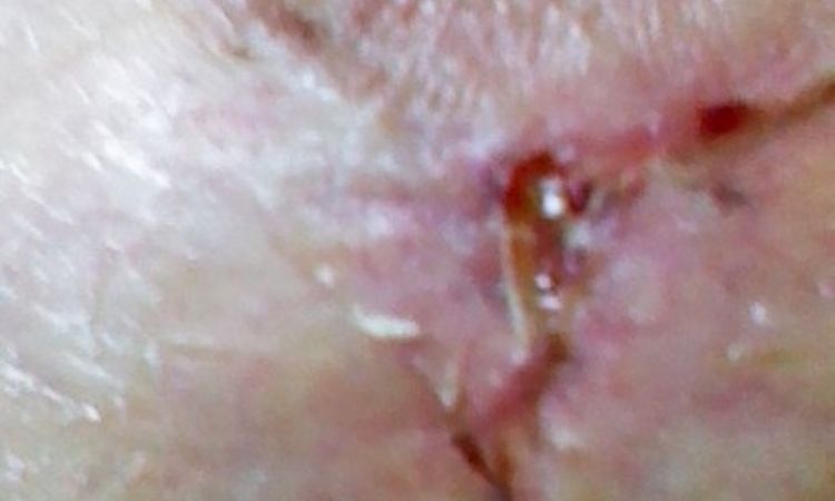 Narbe Nässt Wochen nach OP - Decoderm/Tyrosurgel - 25753