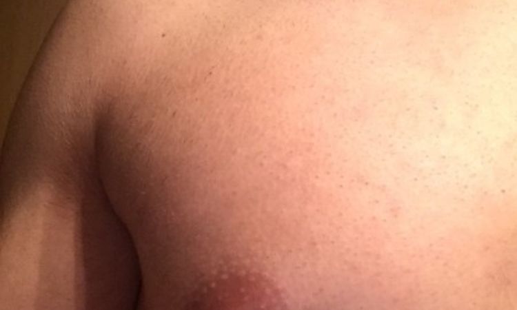 Sehr weiche Brustwarzen nach Verkleinerung - 25803
