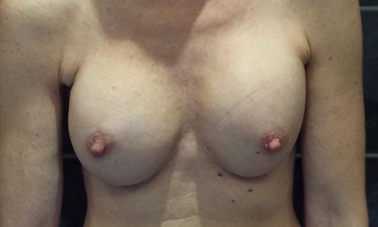 Ungleiche Brüste und keine Dekolleté nach OP - 25810