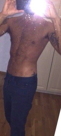 Ist Kompressionsmieder notwendig bei Fettabsaugung am Bauch/Rücken/Brust/Flanken? - 25815