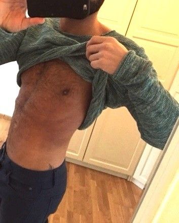 Ist Kompressionsmieder notwendig bei Fettabsaugung am Bauch/Rücken/Brust/Flanken? - 25817