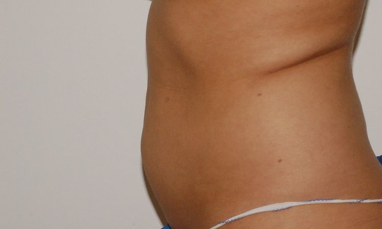 Narben und Beulen 1 Jahr nach Liposuktion - 25824