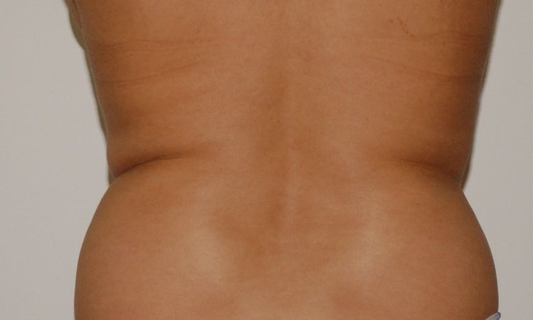 Narben und Beulen 1 Jahr nach Liposuktion - 25825