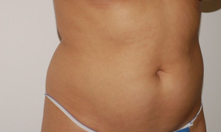 Narben und Beulen 1 Jahr nach Liposuktion - 25826