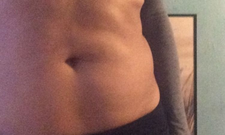 Narben und Beulen 1 Jahr nach Liposuktion - 25827