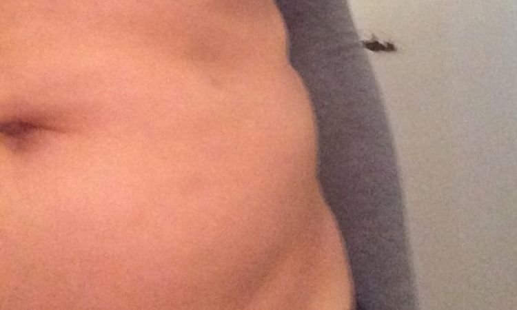 Narben und Beulen 1 Jahr nach Liposuktion - 25829