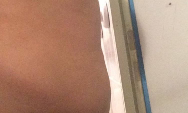 Narben und Beulen 1 Jahr nach Liposuktion - 25830