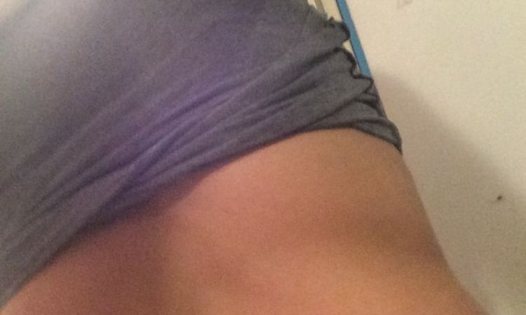 Narben und Beulen 1 Jahr nach Liposuktion - 25831