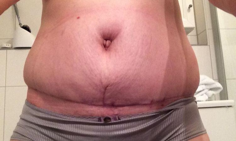Wird mein Bauch noch flach und straff? - 25839
