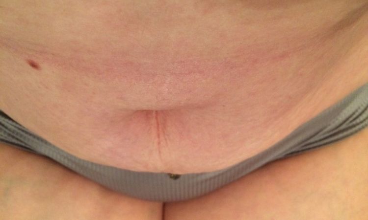 Wird mein Bauch noch flach und straff? - 25842