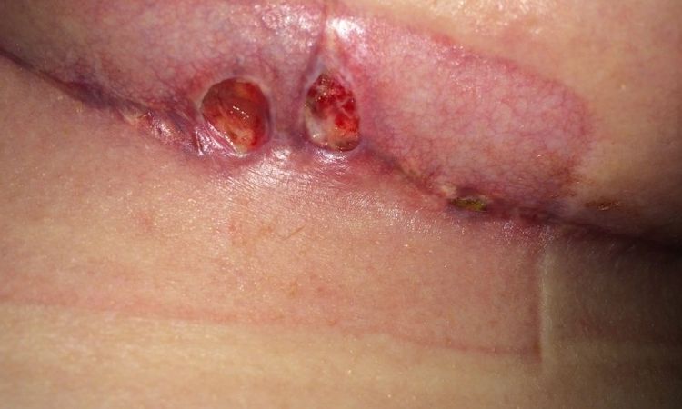 Loch in Brust nach Verkleinerung - 25855