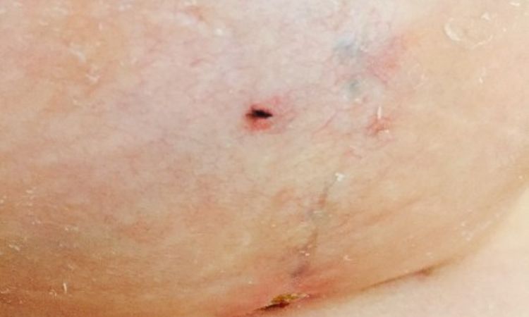 Faden nach Bruststraffung mit Implantat - 25900