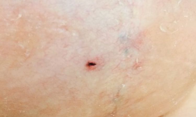 Faden nach Bruststraffung mit Implantat - 25901