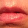Lippenkorrektur nach Gewebeverlust - 25906