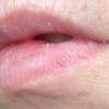 Lippenkorrektur nach Gewebeverlust - 25907