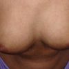 Unterschiedliche Größe der Brüste nach Brustvergrößerung - 25915