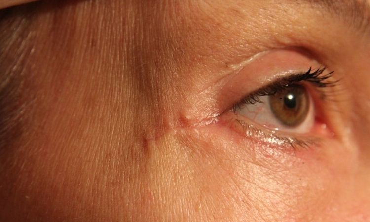 Ektopium und Narbenbildung nach Blepharoplastik - 25919