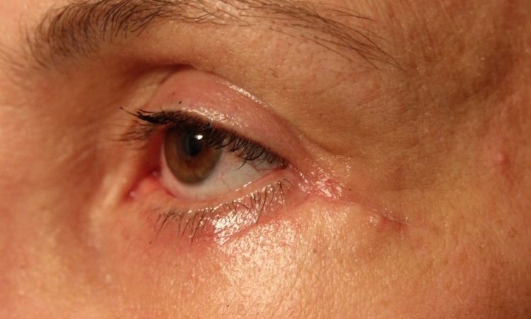 Ektopium und Narbenbildung nach Blepharoplastik - 25920