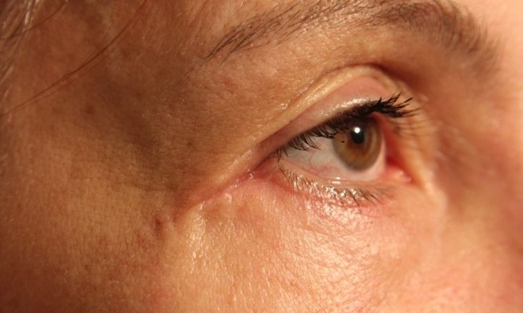 Ektopium und Narbenbildung nach Blepharoplastik - 25921