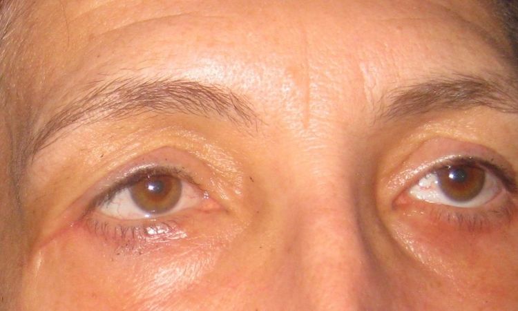 Ektopium und Narbenbildung nach Blepharoplastik - 25922