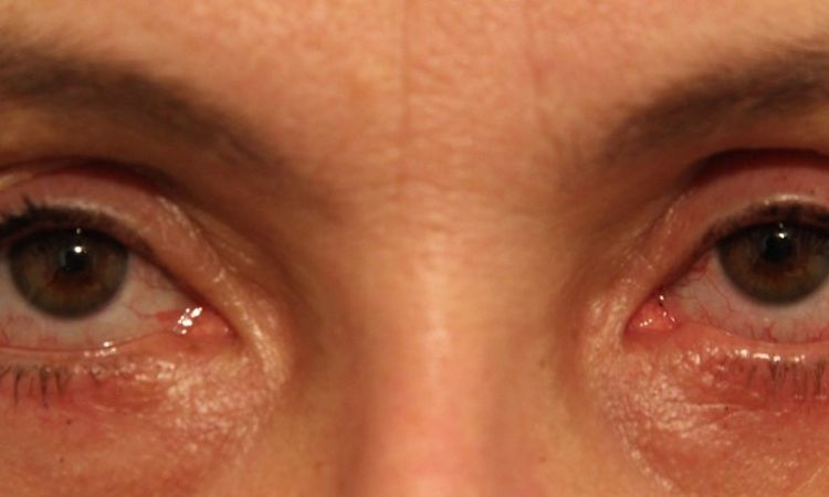 Ektopium und Narbenbildung nach Blepharoplastik - 25923