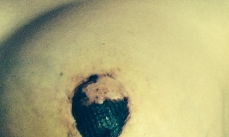 Nekrose nach Brustverkleinerung - 25934