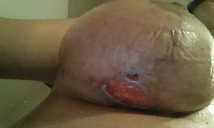 Aufgeplatzte Naht nach Brustvergrößerung - 25964