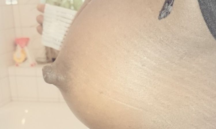 Senkung der Brust nach Brustvergrößerung - 26026