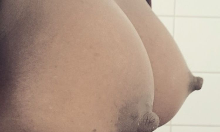 Senkung der Brust nach Brustvergrößerung - 26027