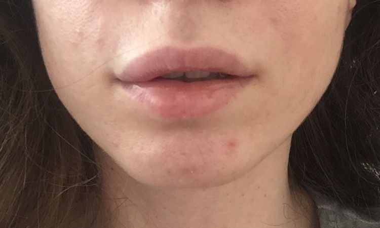 Klumpenbildung nach Hyaluron an den Lippen - 26212