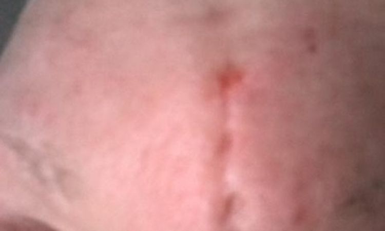 Herausschneiden meiner tiefen Zornesfalte mißlungen - 26218
