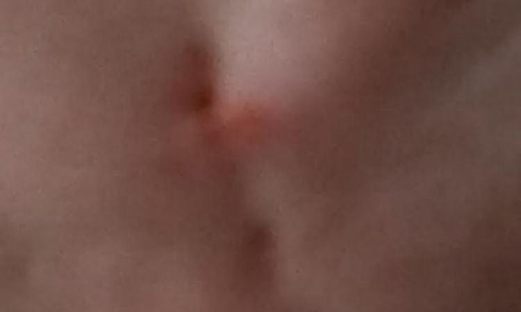 Herausschneiden meiner tiefen Zornesfalte mißlungen - 26219