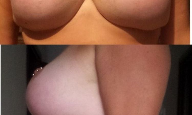 Zweite Brustvergrößerung, da Brustwarzen zu hoch sitzen - 26235