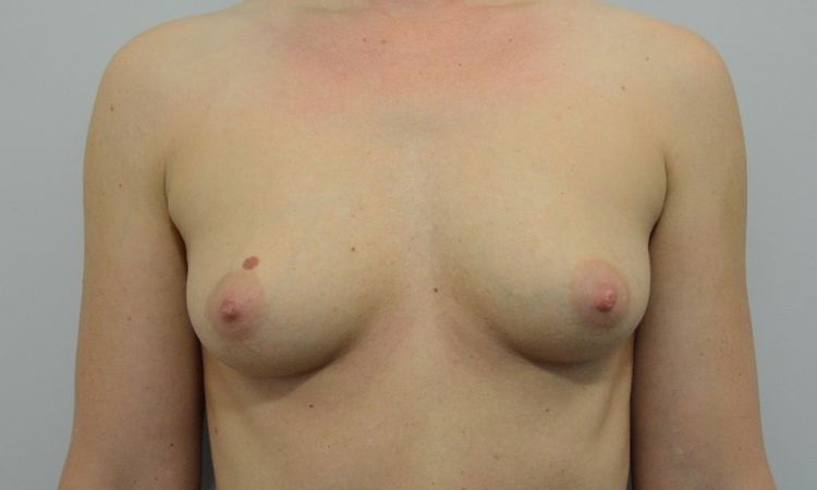 Asymmetrie 2 Wochen  nach Brustvergrößerung - 26244
