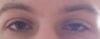 Oberlidkorrektur wegen Ptosis - 26247