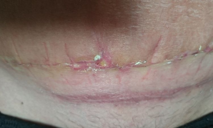 Nekrose nach Bauchdeckenstraffung - 26260