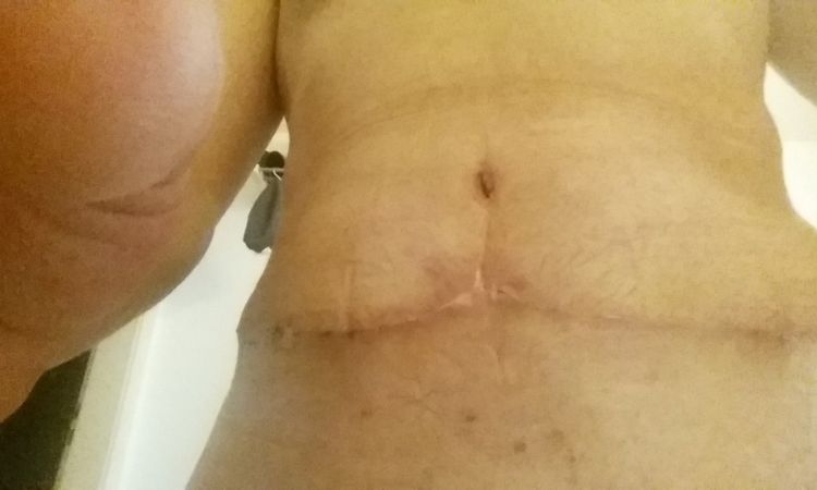 Geschwollener Bauch 3 Wochen nach Bauchstraffung - 26263
