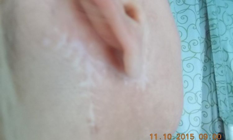 Narben stark zu sehen nach SMAS-Facelift - 26272
