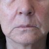 Unterspritzung der Lippenfältchen und Nasolabialfalten - 26281