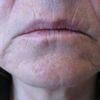 Unterspritzung der Lippenfältchen und Nasolabialfalten - 26282